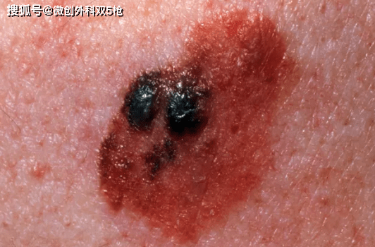 hth华体官方下载app|
身上黑痔小心要了命！掌握ABCDE原则 教你肉眼判断玄色素瘤(图3)