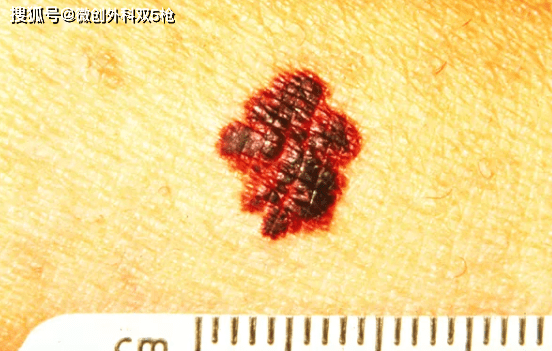 hth华体官方下载app|
身上黑痔小心要了命！掌握ABCDE原则 教你肉眼判断玄色素瘤(图7)