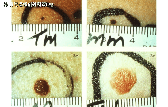 hth华体官方下载app|
身上黑痔小心要了命！掌握ABCDE原则 教你肉眼判断玄色素瘤(图8)